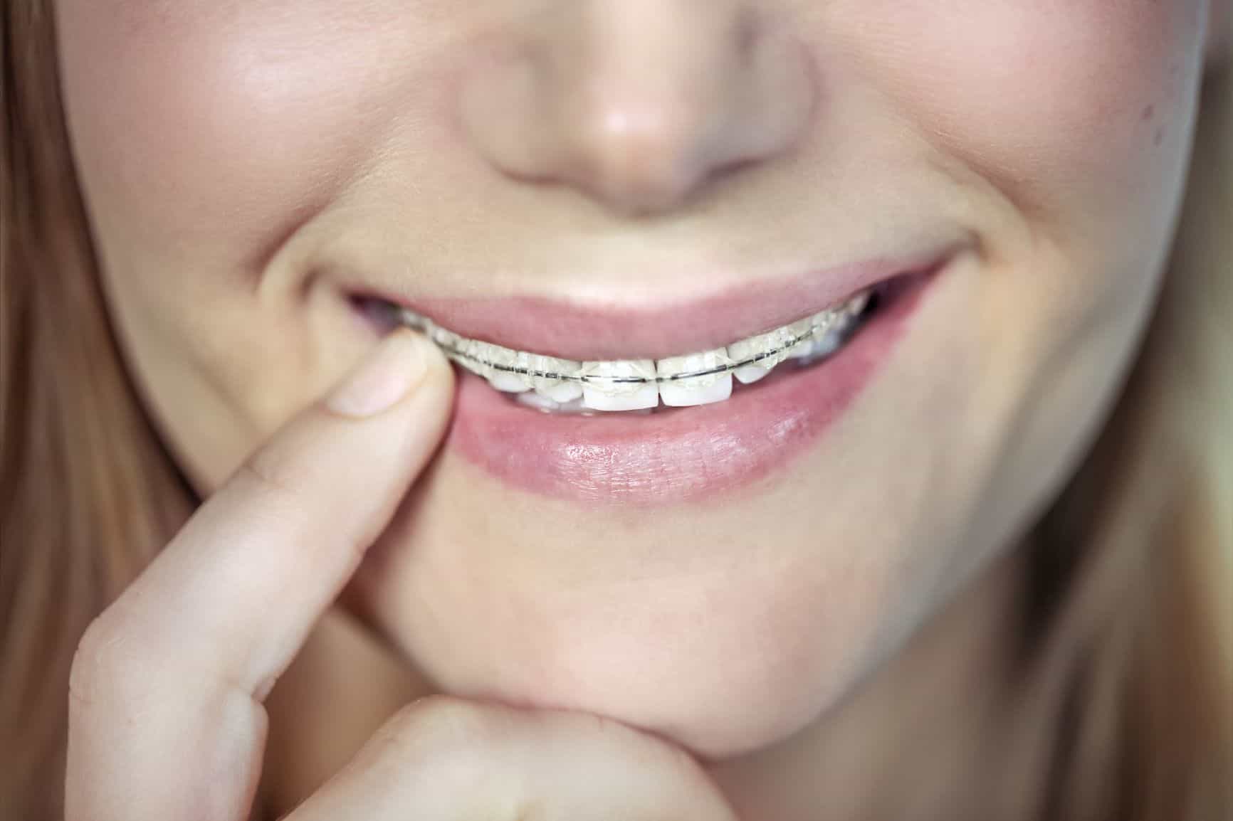 Metal Braces: Pros and Cons - Smiles Orthodontics