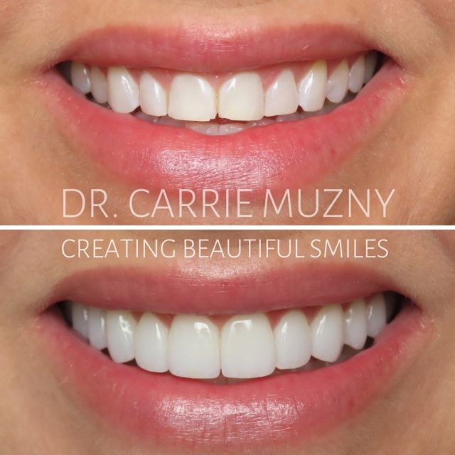 Upper Porcelain Veneers to change the entire look of her smile! 
Love how this turned out✨

FREE COST ESTIMATE⬇️
🔗 link in bio @carriemuznydds 

​​​​​​​​​​​​​​​​​​​​​​​​​​​​​​​​​​​​​​​​​​​​​​​​​​​​​​​​​​​​​​​​🛫 Expedited treatment available for traveling patients 
💵 Financing and monthly payment plans available 
📍 The Woodlands, TX

📲DM: @carriemuznydds ​​​​​​​​​​​​​​​​​​​​​​​​​​​​​​​​​​​​​​​​​​​​​​​​​​​​​​​​​​​​​​​​
📞Phone: 281-298-2205
📧Email: info@muznydds.com
🖥Website: www.carriemuznydds.com

#houstondentist #houstontexas #houston #cosmeticdentistry #veneers #smilesbycarrie #smiledesign