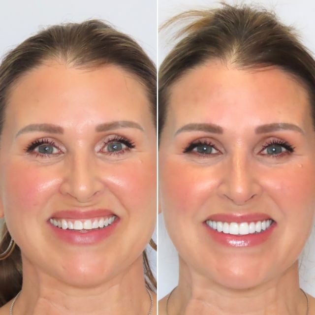 Don’t underestimate the impact of a more youthful smile! 🌟 We took her already good smile, and made it OUTSTANDING with upper porcelain veneers.  Our goal is to always enhance a smile while maintaining each patient’s natural character - This is a very conservative cosmetic enhancement that does not damage your teeth, and can even strengthen and repair your smile while taking years off your appearance.

FREE COST ESTIMATE⬇️
🔗 link in bio @carriemuznydds 

​​​​​​​​​​​​​​​​​​​​​​​​​​​​​​​​​​​​​​​​​​​​​​​​​​​​​​​​​​​​​​​​🛫 Expedited treatment available for traveling patients 
💵 Financing and monthly payment plans available 
📍 The Woodlands, TX

📲DM: @carriemuznydds ​​​​​​​​​​​​​​​​​​​​​​​​​​​​​​​​​​​​​​​​​​​​​​​​​​​​​​​​​​​​​​​​
📞Phone: 281-298-2205
📧Email: info@muznydds.com
🖥Website: www.carriemuznydds.com

#houstondentist #houstontexas #houston #cosmeticdentistry #veneers #smilesbycarrie #smiledesign