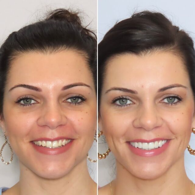 ✨Creating a smile that lights up a face and feels authentically “YOU”is what we’re all about! 🥰This stunning transformation highlights the difference a confident, radiant smile can make— 
This is a lot more than just making pretty teeth! ☺️

Thank you to our wonderful patient for trusting us with her smile makeover journey. Getting to be a part of this smile transformation meant the world to us! 

FREE COST ESTIMATE⬇️
🔗 link in bio @carriemuznydds 

​​​​​​​​​​​​​​​​​​​​​​​​​​​​​​​​​​​​​​​​​​​​​​​​​​​​​​​​​​​​​​​​🛫 Expedited treatment available for traveling patients 
💵 Financing and monthly payment plans available 
📍 The Woodlands, TX

📲DM: @carriemuznydds ​​​​​​​​​​​​​​​​​​​​​​​​​​​​​​​​​​​​​​​​​​​​​​​​​​​​​​​​​​​​​​​​
📞Phone: 281-298-2205
📧Email: info@muznydds.com
🖥Website: www.carriemuznydds.com

#houstoncosmeticdentists #houstondentist #newsmile #preplessveneers #porcelainveneers #smilesbycarrie #veneers #newsmile #montgomerytx #thewoodlandsTx
#conroetx