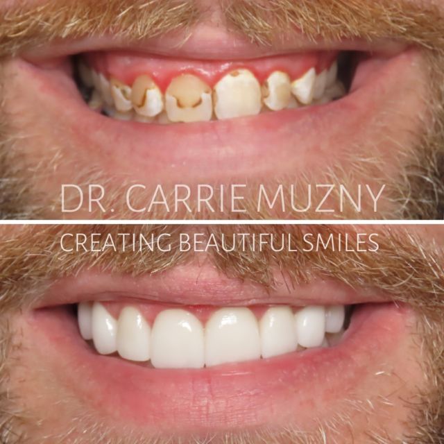 He did not like the look or discoloration of his smile. We were able to use 8 Crowns, gum therapy and fillings to completely transform the look and health of his smile. 

FREE COST ESTIMATE⬇️
🔗 link in bio @carriemuznydds 

​​​​​​​​​​​​​​​​​​​​​​​​​​​​​​​​​​​​​​​​​​​​​​​​​​​​​​​​​​​​​​​​🛫 Expedited treatment available for traveling patients 
💵 Financing and monthly payment plans available 
📍 The Woodlands, TX

📲DM: @carriemuznydds ​​​​​​​​​​​​​​​​​​​​​​​​​​​​​​​​​​​​​​​​​​​​​​​​​​​​​​​​​​​​​​​​
📞Phone: 281-298-2205
📧Email: info@muznydds.com
🖥Website: www.carriemuznydds.com

#houstondentist #houstontexas #houston #cosmeticdentistry #veneers #smilesbycarrie #smiledesign #porcelainveneers #compositeveneers