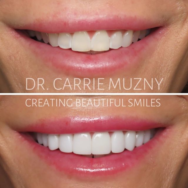 From beautiful to breathtaking! 🤩 Some people can just pull off our lightest, most vibrant veneers, and she is definitely one of them! 
These stunning veneers did NOT require drilling the teeth down, and added the desired fullness and brightness she wanted! 
A true smile enhancement that we just adore! 🥰

FREE COST ESTIMATE⬇️
🔗 link in bio @carriemuznydds 

​​​​​​​​​​​​​​​​​​​​​​​​​​​​​​​​​​​​​​​​​​​​​​​​​​​​​​​​​​​​​​​​🛫 Expedited treatment available for traveling patients 
💵 Financing and monthly payment plans available 
📍 The Woodlands, TX

📲DM: @carriemuznydds ​​​​​​​​​​​​​​​​​​​​​​​​​​​​​​​​​​​​​​​​​​​​​​​​​​​​​​​​​​​​​​​​
📞Phone: 281-298-2205
📧Email: info@muznydds.com
🖥Website: www.carriemuznydds.com

#houstondentist #houstontexas #houston #cosmeticdentistry #veneers #smilesbycarrie #smiledesign #porcelainveneers #compositeveneers