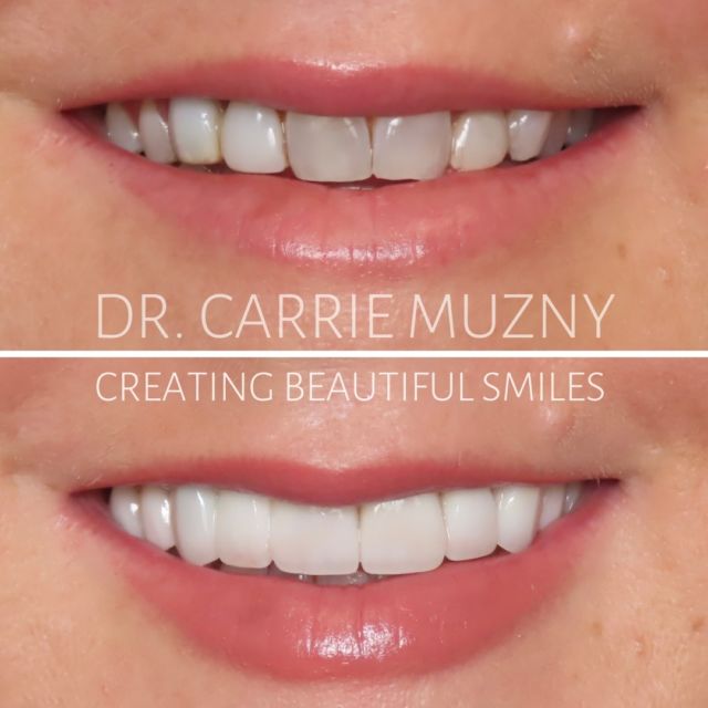 I hear from patients all the time "I wish I would've done this sooner!" Upper Porcelain Veneers to give her a smile she will love and feel confident in ⭐️

FREE COST ESTIMATE⬇️
🔗 link in bio @carriemuznydds 

​​​​​​​​​​​​​​​​​​​​​​​​​​​​​​​​​​​​​​​​​​​​​​​​​​​​​​​​​​​​​​​​🛫 Expedited treatment available for traveling patients 
💵 Financing and monthly payment plans available 
📍 The Woodlands, TX

📲DM: @carriemuznydds ​​​​​​​​​​​​​​​​​​​​​​​​​​​​​​​​​​​​​​​​​​​​​​​​​​​​​​​​​​​​​​​​
📞Phone: 281-298-2205
📧Email: info@muznydds.com
🖥Website: www.carriemuznydds.com

#houstondentist #houstontexas #houston #cosmeticdentistry #veneers #smilesbycarrie #smiledesign #porcelainveneers #compositeveneers