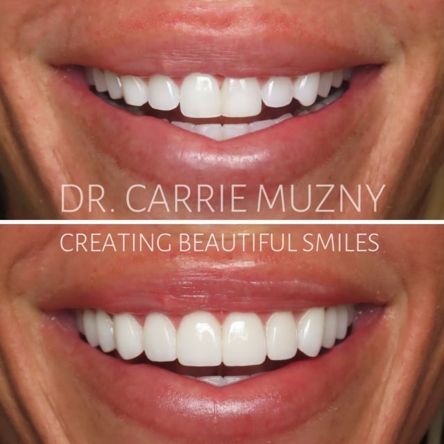 ✨Another 10/10!  A good smile turned SPECTACULAR! 🤩  10 upper veneers designed to create a permanently lighter smile, with more symmetrical proportions, that just fit her perfectly! 
This smile is connected to the NICEST person ever as well! 💕 Thank you Danielle for trusting me! 

FREE COST ESTIMATE⬇️
🔗 link in bio @carriemuznydds 

​​​​​​​​​​​​​​​​​​​​​​​​​​​​​​​​​​​​​​​​​​​​​​​​​​​​​​​​​​​​​​​​🛫 Expedited treatment available for traveling patients 
💵 Financing and monthly payment plans available 
📍 The Woodlands, TX

📲DM: @carriemuznydds ​​​​​​​​​​​​​​​​​​​​​​​​​​​​​​​​​​​​​​​​​​​​​​​​​​​​​​​​​​​​​​​​
📞Phone: 281-298-2205
📧Email: info@muznydds.com
🖥Website: www.carriemuznydds.com

#houstondentist #houstontexas #houston #cosmeticdentistry #veneers #smilesbycarrie #smiledesign