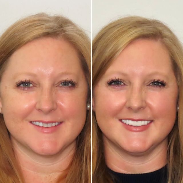 Transforming smiles, one veneer at a time! 🌟😁 Thrilled to see the confidence and radiance of this beautiful smile

FREE COST ESTIMATE⬇️
🔗 link in bio @carriemuznydds 

​​​​​​​​​​​​​​​​​​​​​​​​​​​​​​​​​​​​​​​​​​​​​​​​​​​​​​​​​​​​​​​​🛫 Expedited treatment available for traveling patients 
💵 Financing and monthly payment plans available 
📍 The Woodlands, TX

📲DM: @carriemuznydds ​​​​​​​​​​​​​​​​​​​​​​​​​​​​​​​​​​​​​​​​​​​​​​​​​​​​​​​​​​​​​​​​
📞Phone: 281-298-2205
📧Email: info@muznydds.com
🖥Website: www.carriemuznydds.com

#houstondentist #houstontexas #houston #cosmeticdentistry #veneers #smilesbycarrie #smiledesign #porcelainveneers #compositeveneers