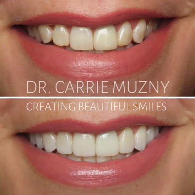 ✨A beautiful smile can change everything! ✨ Porcelain veneers create a lighter, more balanced smile that radiates youth while still maintaining a natural beauty! We just LOVED this one and this amazing patient! 🥰 

FREE COST ESTIMATE⬇️
🔗 link in bio @carriemuznydds 

​​​​​​​​​​​​​​​​​​​​​​​​​​​​​​​​​​​​​​​​​​​​​​​​​​​​​​​​​​​​​​​​🛫 Expedited treatment available for traveling patients 
💵 Financing and monthly payment plans available 
📍 The Woodlands, TX

📲DM: @carriemuznydds ​​​​​​​​​​​​​​​​​​​​​​​​​​​​​​​​​​​​​​​​​​​​​​​​​​​​​​​​​​​​​​​​
📞Phone: 281-298-2205
📧Email: info@muznydds.com
🖥Website: www.carriemuznydds.com

#houstoncosmeticdentists #houstondentist #newsmile #preplessveneers #porcelainveneers #smilesbycarrie #veneers #newsmile #montgomerytx #thewoodlandsTx
#conroetx