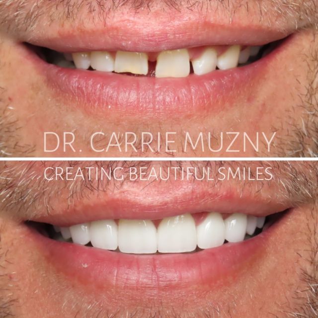 This awesome patient and his wife flew in to see us! He came in to improve his smile and we did just that! We used Upper Porcelain Veneers to add brightness, symmetry, and close the spacing. 

FREE COST ESTIMATE⬇️
🔗 link in bio @carriemuznydds 

​​​​​​​​​​​​​​​​​​​​​​​​​​​​​​​​​​​​​​​​​​​​​​​​​​​​​​​​​​​​​​​​🛫 Expedited treatment available for traveling patients 
💵 Financing and monthly payment plans available 
📍 The Woodlands, TX

📲DM: @carriemuznydds ​​​​​​​​​​​​​​​​​​​​​​​​​​​​​​​​​​​​​​​​​​​​​​​​​​​​​​​​​​​​​​​​
📞Phone: 281-298-2205
📧Email: info@muznydds.com
🖥Website: www.carriemuznydds.com

#houstondentist #houstontexas #houston #cosmeticdentistry #veneers #smilesbycarrie #smiledesign #porcelainveneers #compositeveneers