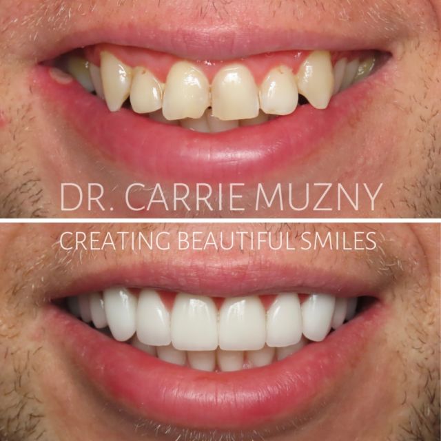 A life changing smile transformation for this patient. Upper and Lower Porcelain Veneers to give him a completely new smile. 

FREE COST ESTIMATE⬇️
🔗 link in bio @carriemuznydds 

​​​​​​​​​​​​​​​​​​​​​​​​​​​​​​​​​​​​​​​​​​​​​​​​​​​​​​​​​​​​​​​​🛫 Expedited treatment available for traveling patients 
💵 Financing and monthly payment plans available 
📍 The Woodlands, TX

📲DM: @carriemuznydds ​​​​​​​​​​​​​​​​​​​​​​​​​​​​​​​​​​​​​​​​​​​​​​​​​​​​​​​​​​​​​​​​
📞Phone: 281-298-2205
📧Email: info@muznydds.com
🖥Website: www.carriemuznydds.com

#houstondentist #houstontexas #houston #cosmeticdentistry #veneers #smilesbycarrie #smiledesign