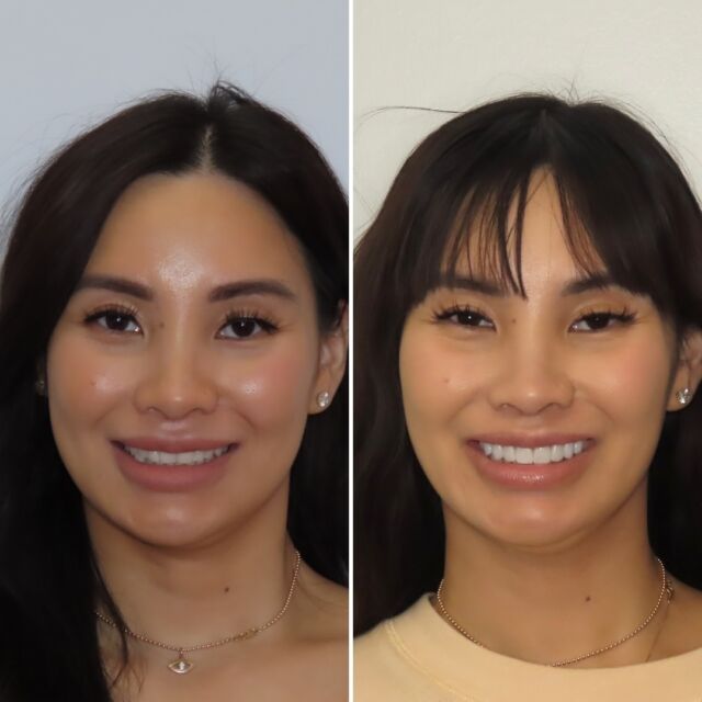 Loving this smile we were able to create for her. Another great example of small changes to make a beautiful smile and a dramatic impact. 

FREE COST ESTIMATE⬇️
🔗 link in bio @carriemuznydds 

​​​​​​​​​​​​​​​​​​​​​​​​​​​​​​​​​​​​​​​​​​​​​​​​​​​​​​​​​​​​​​​​🛫 Expedited treatment available for traveling patients 
💵 Financing and monthly payment plans available 
📍 The Woodlands, TX

📲DM: @carriemuznydds ​​​​​​​​​​​​​​​​​​​​​​​​​​​​​​​​​​​​​​​​​​​​​​​​​​​​​​​​​​​​​​​​
📞Phone: 281-298-2205
📧Email: info@muznydds.com
🖥Website: www.carriemuznydds.com

#houstoncosmeticdentists #houstondentist #newsmile #preplessveneers #porcelainveneers #smilesbycarrie #veneers #newsmile