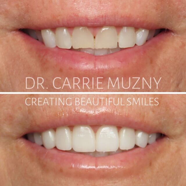 Subtle yet striking! Our smile makeovers focus on enhancing your natural smile in a way that looks uniquely YOU! Every transformation is crafted to make a dramatic impact while keeping things beautifully authentic, and is what truly sets us apart! 
Many smiles are lacking the volume they need as we age, so adding some length and brightness can make all the difference! 

FREE COST ESTIMATE⬇️
🔗 link in bio @carriemuznydds 

​​​​​​​​​​​​​​​​​​​​​​​​​​​​​​​​​​​​​​​​​​​​​​​​​​​​​​​​​​​​​​​​🛫 Expedited treatment available for traveling patients 
💵 Financing and monthly payment plans available 
📍 The Woodlands, TX

📲DM: @carriemuznydds ​​​​​​​​​​​​​​​​​​​​​​​​​​​​​​​​​​​​​​​​​​​​​​​​​​​​​​​​​​​​​​​​
📞Phone: 281-298-2205
📧Email: info@muznydds.com
🖥Website: www.carriemuznydds.com

#houstoncosmeticdentists #houstondentist #newsmile #preplessveneers #porcelainveneers #smilesbycarrie #veneers #newsmile